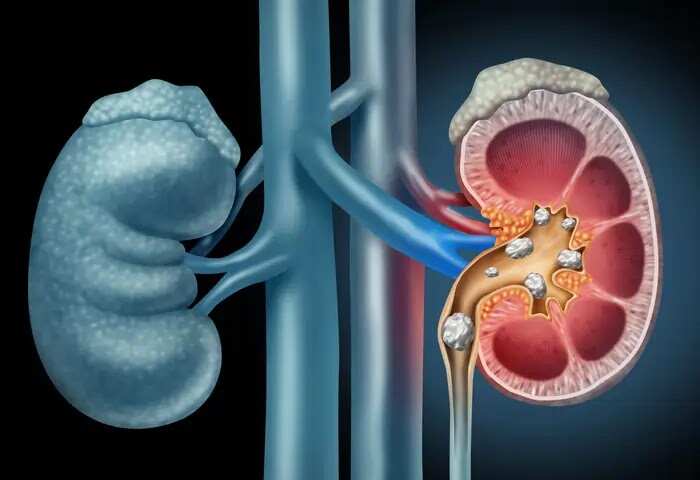 Kidney Stone | മൂത്രത്തില് കല്ല് അസഹനീയമാണ്; രോഗം വരാതിരിക്കാന് ചെയ്യേണ്ടത്