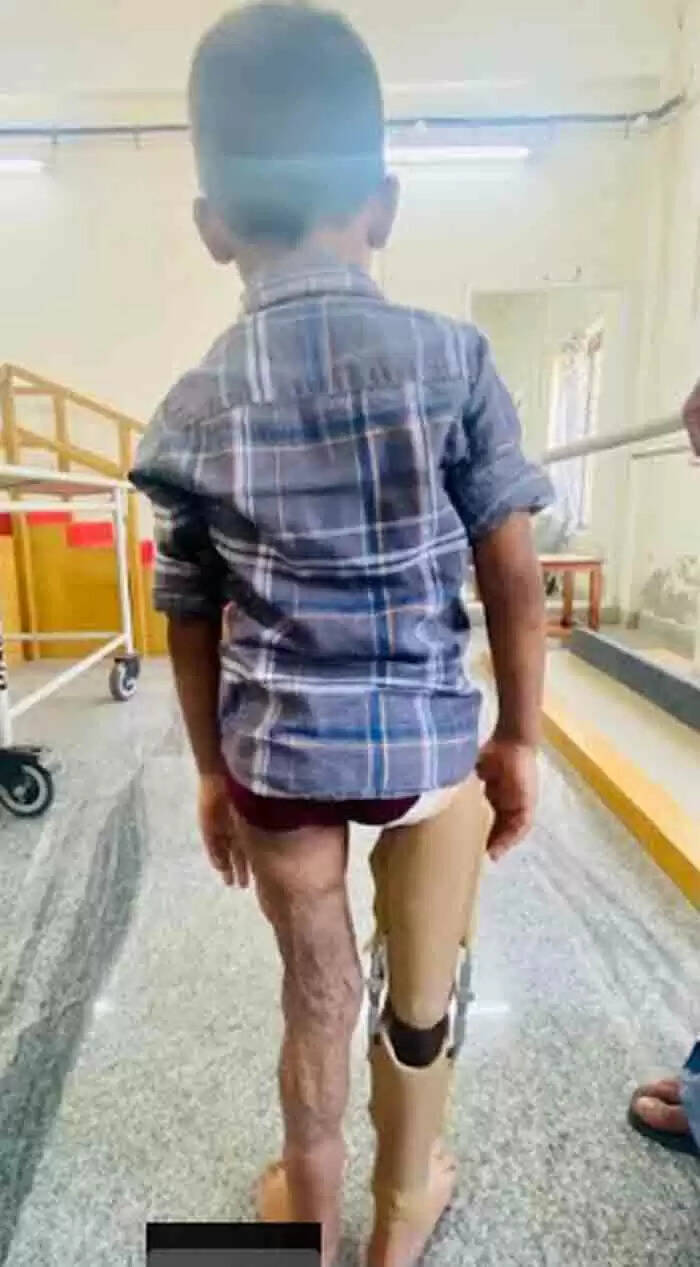 Treatment | അപകടത്തെ തുടര്ന്ന് മുട്ടിന് മീതെവച്ച് വലതുകാല് നഷ്ടപ്പെട്ട 5 വയസുകാരന് കൃത്രിമ കാലിലൂടെ ഇനിയും നടക്കാം; സ്വപ്നങ്ങള്ക്ക് പുത്തനുണര്വേകി തൃശൂര് മെഡികല് കോളജ്
