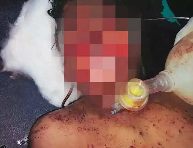 മൊബൈല് ഫോണ് സ്ഫോടനത്തില് യുവാവിന്റെ മുഖം തകര്ന്നു