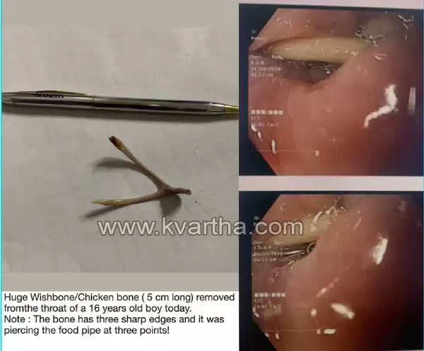 പതിനാറുകാരന്റെ അന്നനാളത്തില്‍ കുടുങ്ങിയ കോഴിയിറച്ചിയിലെ എല്ല് കിംസ്‌ഹെല്‍ത്തില്‍ എന്‍ഡോസ്‌കോപ്പിയിലൂടെ നീക്കം ചെയ്തു