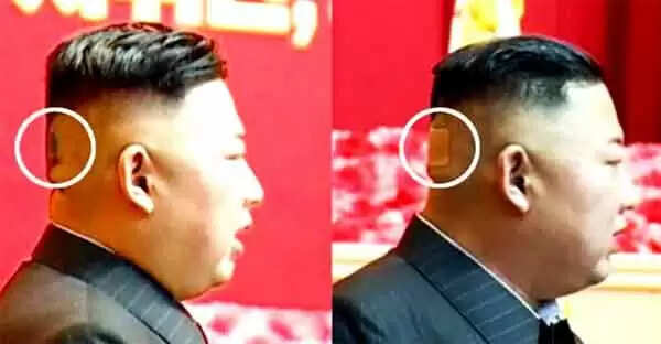 തലയ്ക്ക് പിന്നില് വലിയ ബാന്ഡേജ്; കിം ജോങ് ഉന്നിന്റെ ആരോഗ്യസ്ഥിതിയില് വീണ്ടും അഭ്യൂഹം