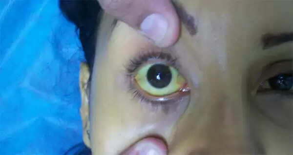 ചങ്ങനാശ്ശേരിയില് മഞ്ഞപ്പിത്തം പടരുന്നു; ആരോഗ്യ വിഭാഗം മൗനത്തില്, ഒരു ഹോസ്റ്റലിലെ 100 ഓളം വിദ്യാര്ത്ഥിനികള് ചികിത്സയില്