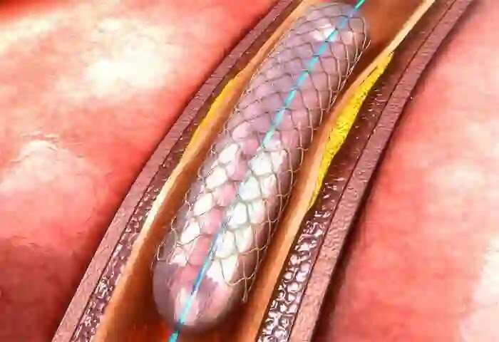 Stent Rima Stent | സ്റ്റെന്റിന് കുറവ് വന്നാല് പരിഹരിക്കാന് ഉടനടി നടപടി: നൂതന ...