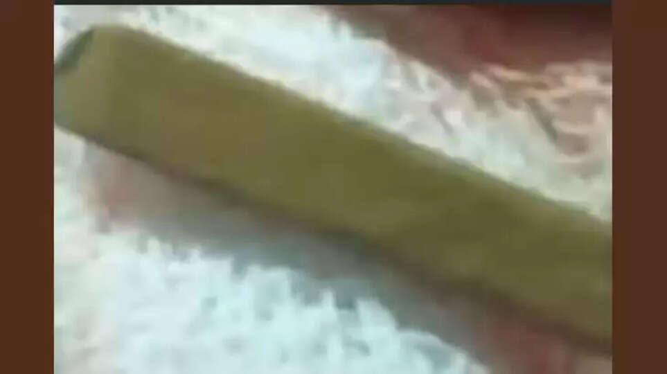 Pencil Removed from Child's Nose in Rare Surgery at Kannur Medical College