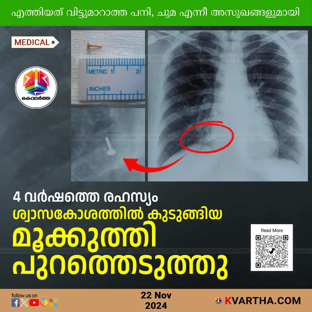 nose stud removed from womans lung after 4 years