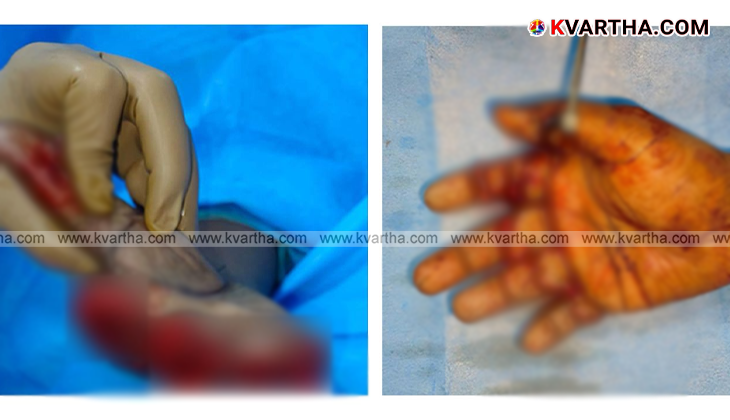 Medical team at Aster Mims Kannur after the successful surgery.