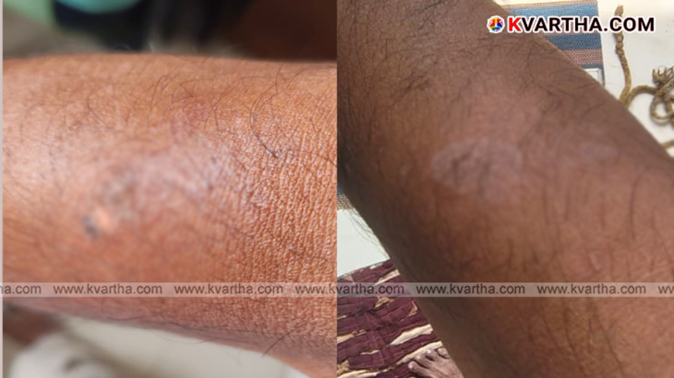 A symbolic scene of channel cameraman Shaji Keezhara suffering from sunstroke at Cherukunni, Kannur.&nbsp;