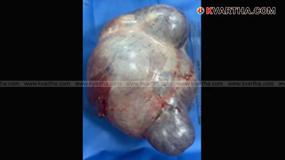 Successful tumor removal surgery in Kannur Aster MI