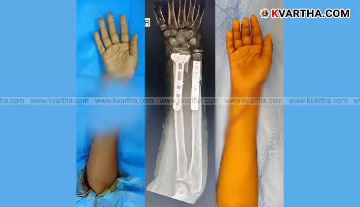 Rare Surgery: A 10-Year-Old’s Severed Hand Successfully Reattached at Aster MIMS