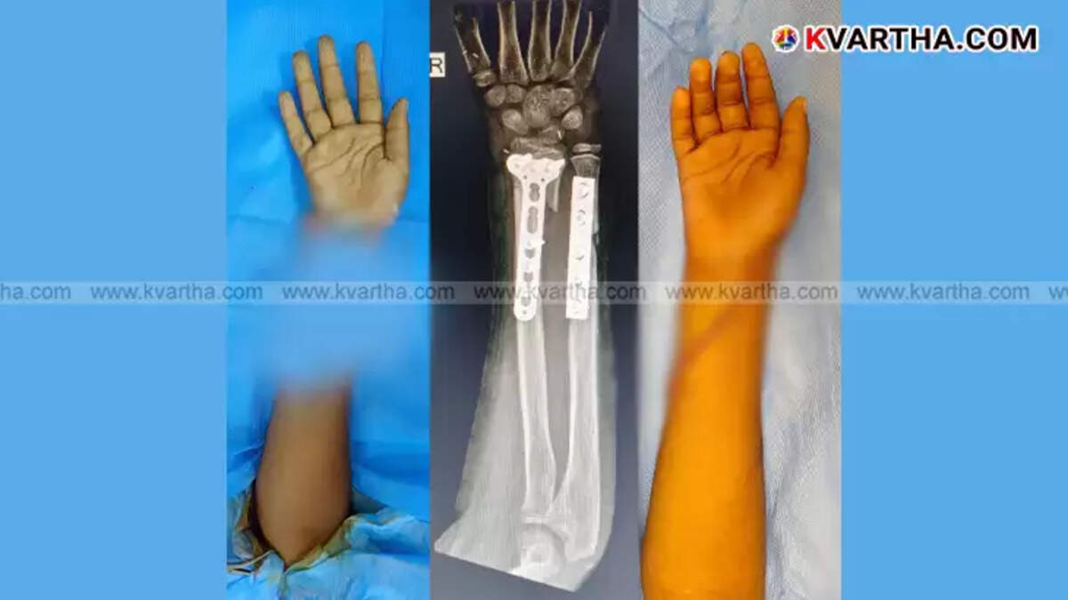 Rare Surgery: A 10-Year-Old&rsquo;s Severed Hand Successfully Reattached at Aster MIMS