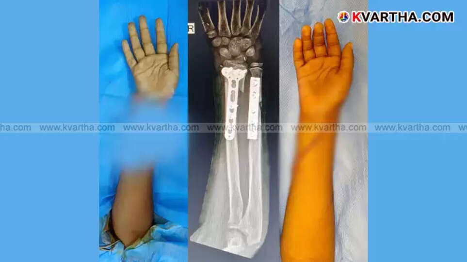 Rare Surgery: A 10-Year-Old’s Severed Hand Successfully Reattached at Aster MIMS