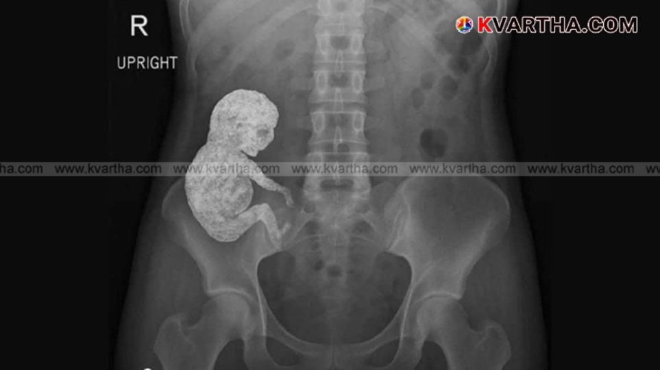 X-ray image showing a lithopedion or 'stone baby'