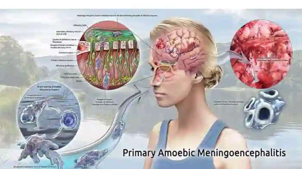 14-year-old Kozhikode boy tests positive for Amoebic meningoencephalitis, 4th case in two months, Kozhikode, Amoebic Meningoencephalitis, Hospital, Treatment, Doctors, 4th case, Kerala News