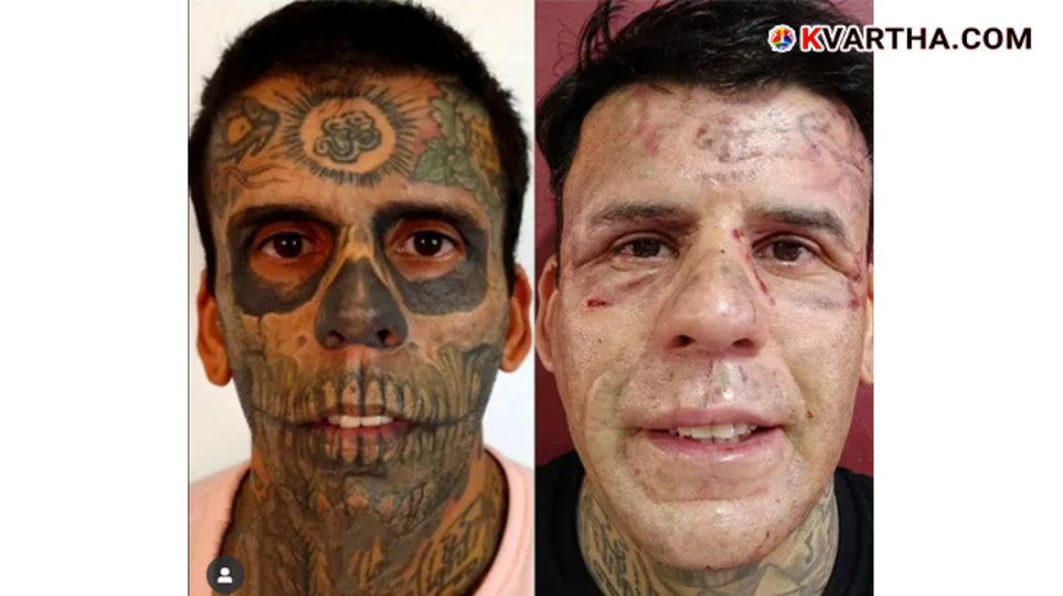 A photo of Leandro De Souza after his tattoo removal procedure.