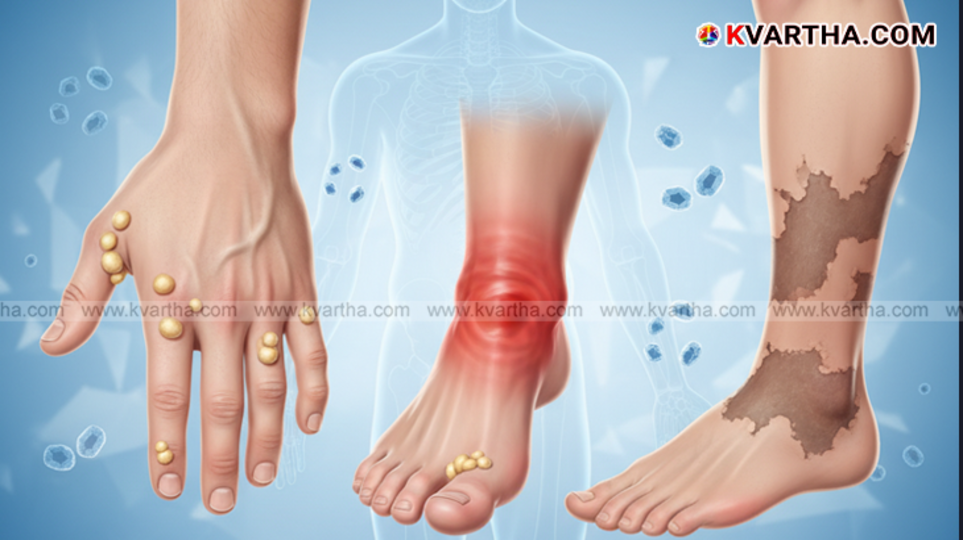 Close-up of tophi nodules on a finger or joint