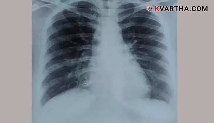 Nose Stud Removed from Woman's Lung After 4 Years