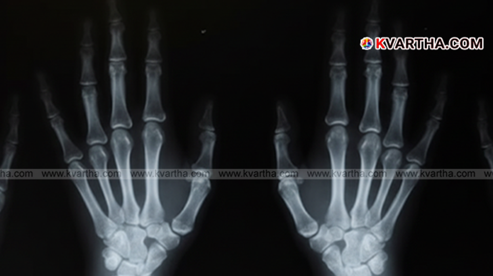 A conceptual image of the new bone glue developed by Chinese researchers.