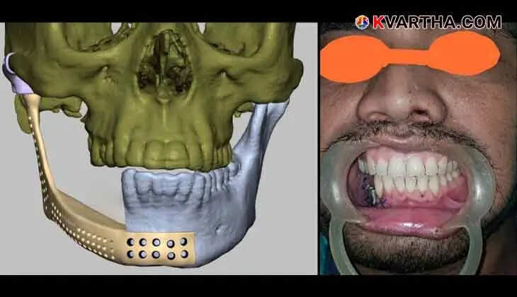  Kannur Govt Medical College Pioneers 3D Printing for Oral Surgery