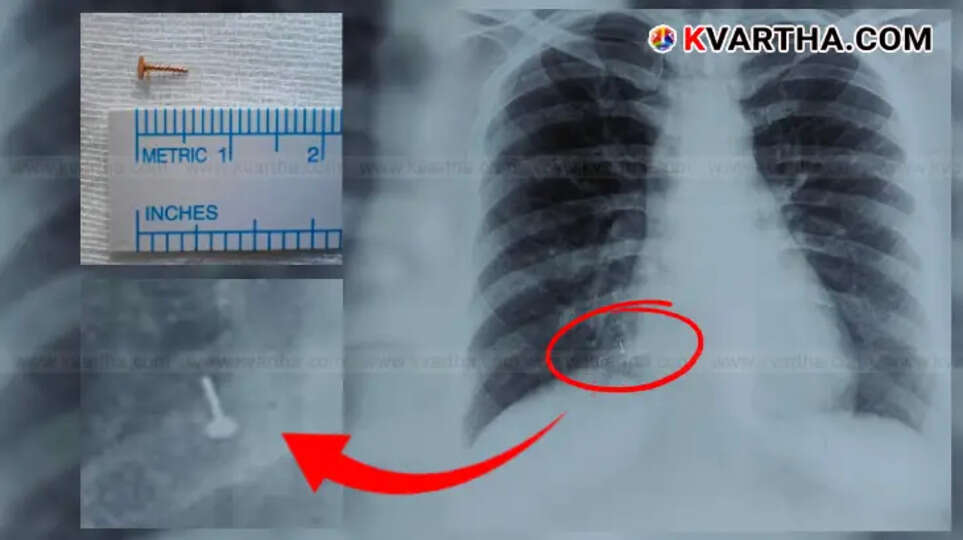 nose stud removed from womans lung after 4 years