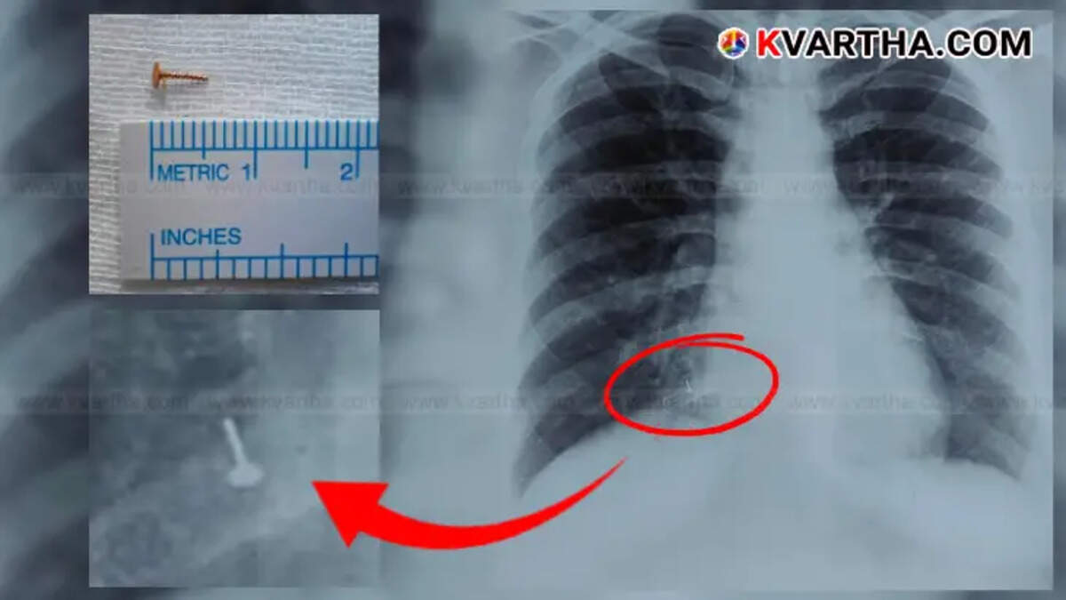 nose stud removed from womans lung after 4 years