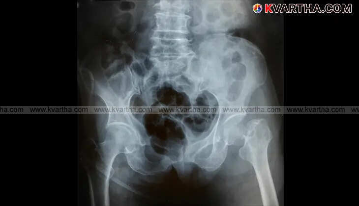 Osteoporosis effects on bones and health