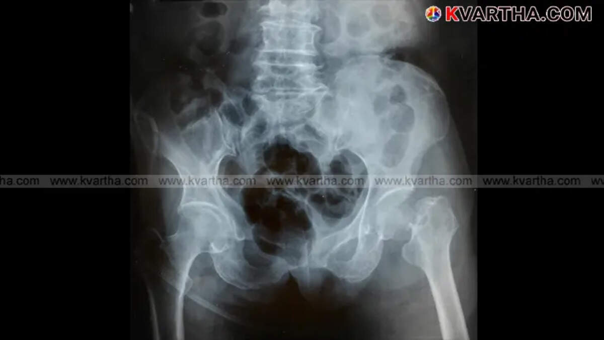 Osteoporosis effects on bones and health