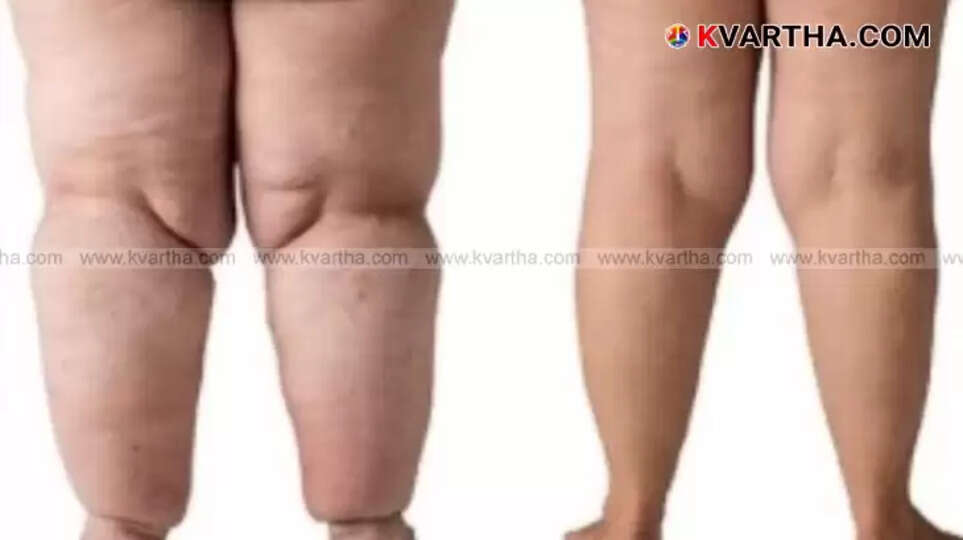 Lipedema: A Threat to Indian Women's Health
