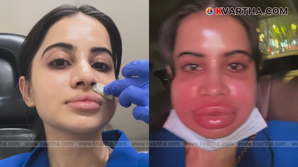 Urfi Javed with distorted lips after a botched lip filler procedure