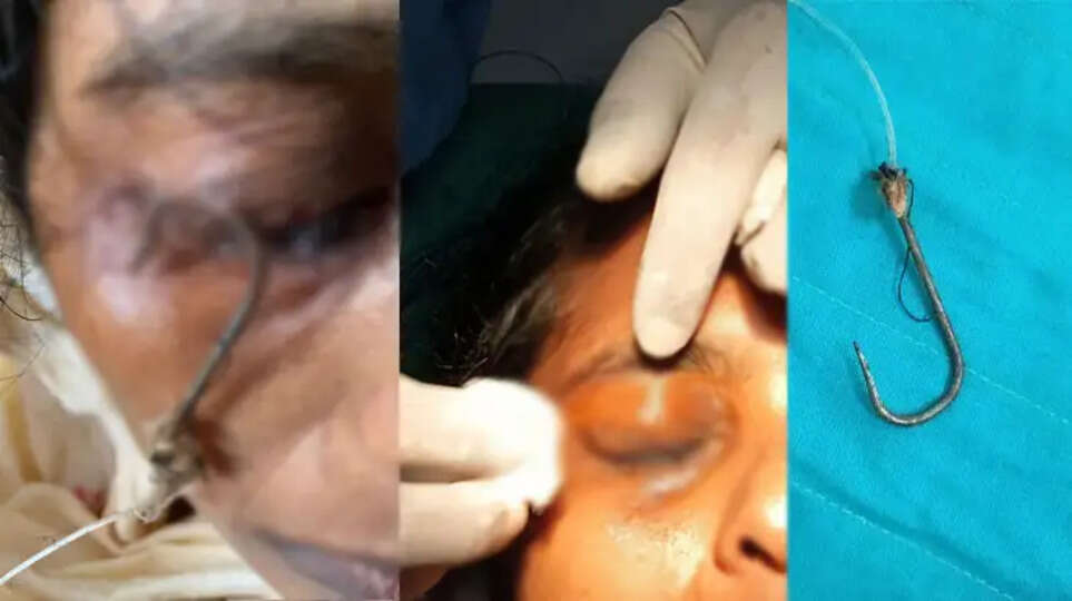 A medical team performing a fish hook removal surgery