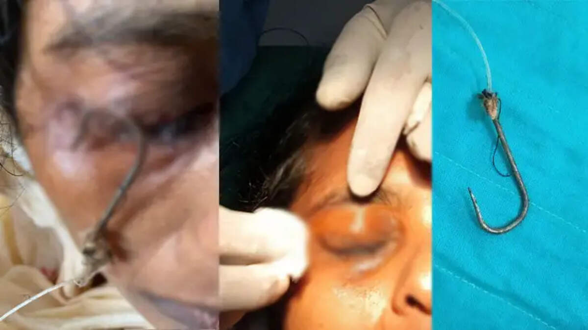 A medical team performing a fish hook removal surgery