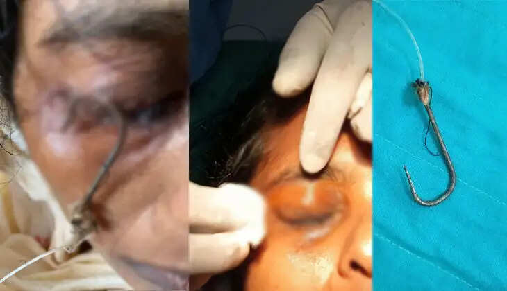 A medical team performing a fish hook removal surgery