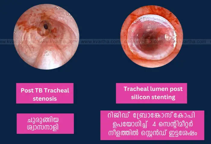 narrowed trachea was restored by treatment