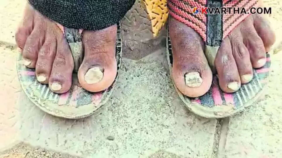 Nail Loss Villager in Buldhana, Maharashtra