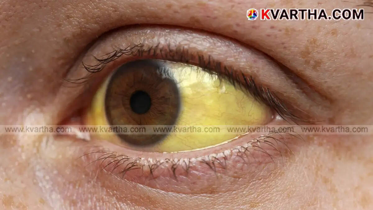 Image Representing One dead, around 100 infected in Jaundice outbreak linked to new hotel in Wandoor; health dept intensifies inspections