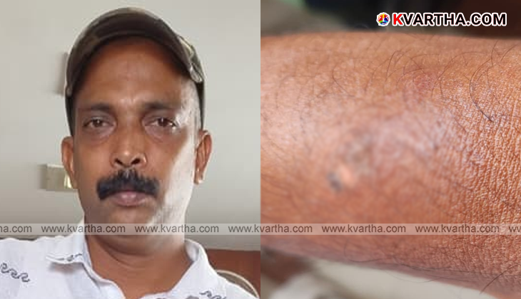 ചെറുകുന്നിൽ ചാനൽ ക്യാമറാമാന് സൂര്യാഘാതമേറ്റു; കടുത്ത ചൂടിൽ വടക്കൻ ജില്ലകൾ വെന്തുരുകുന്നു